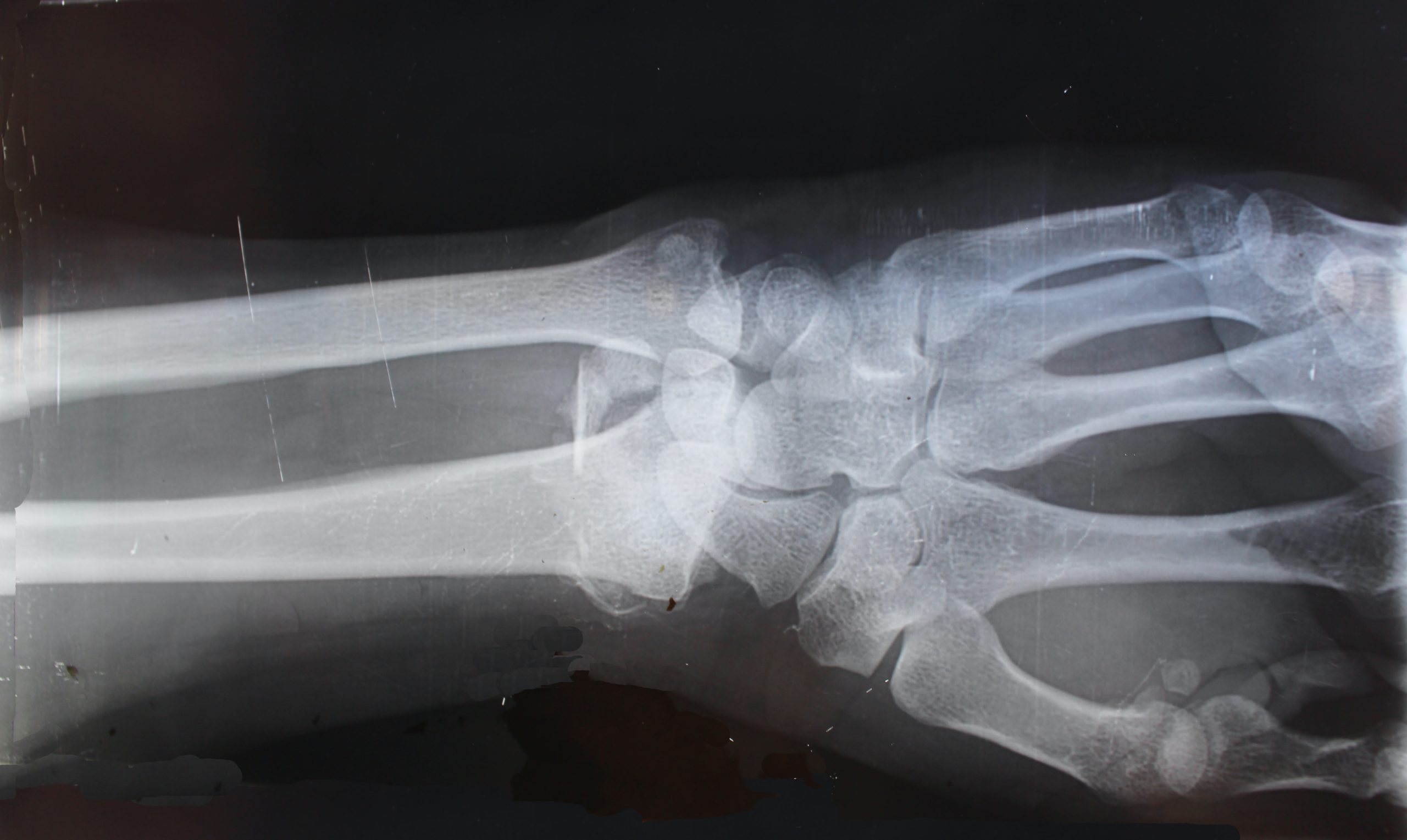 Exemple de radiographie du poignet